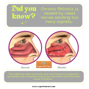 An Infographic Image Highlighting Nasal Chronic Rhinitis at Expert ENT Care